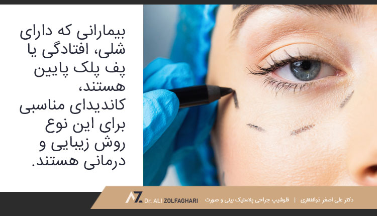 کاندیدای مناسب برای جراحی زیبایی کانتوپلاستی