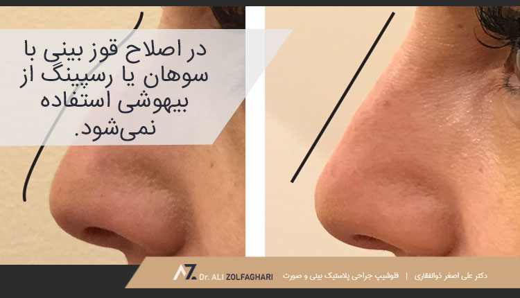 اصلاح قوز بینی با سوهان یا رسپینگ