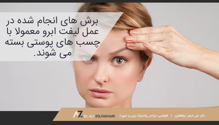 بستن برش ها