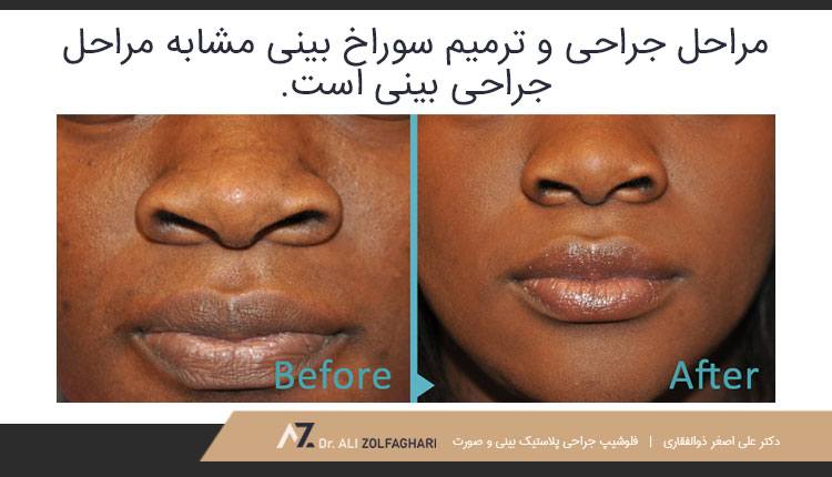 مراحل انجام جراحی سوراخ بینی