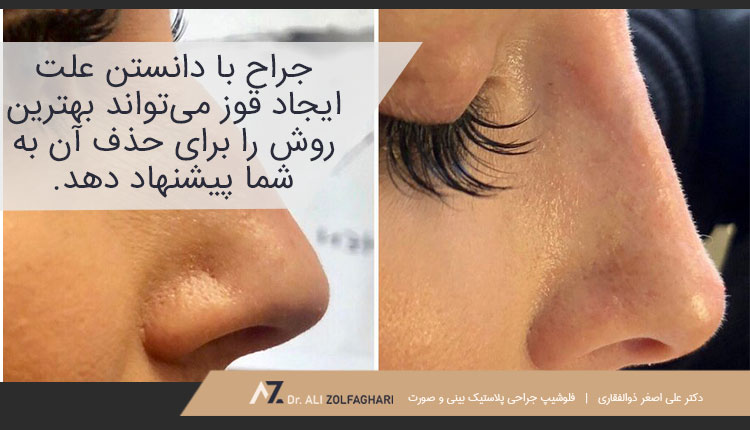دلایل ایجاد قوز بینی