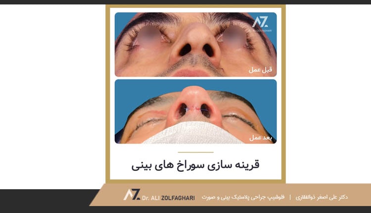 قرینه سازی سوراخ های بینی