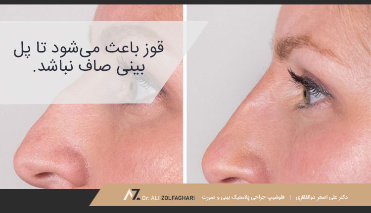 قوز بینی و انواع آن