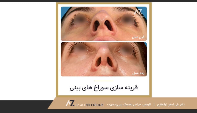 نمونه کار ترمیم سوراخ بینی
