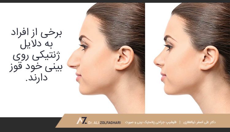 دلایل ژنتیک قوز بینی
