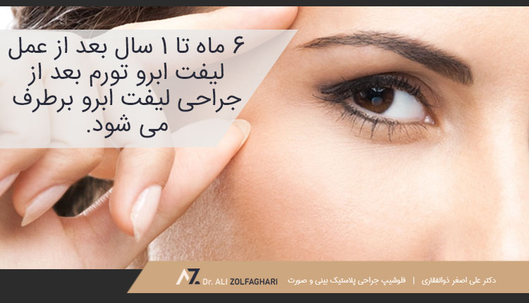 6 ماه تا 1 سال بعد از عمل لیفت ابرو
