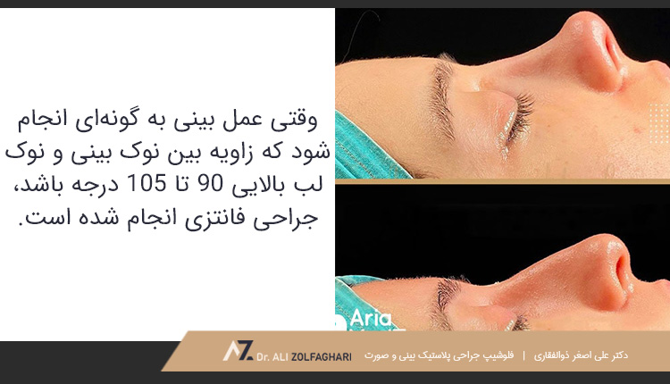 عمل بینی فانتزی عروسکی مناسب چه کسانی است؟ شناخت سبک عکس قبل و بعد