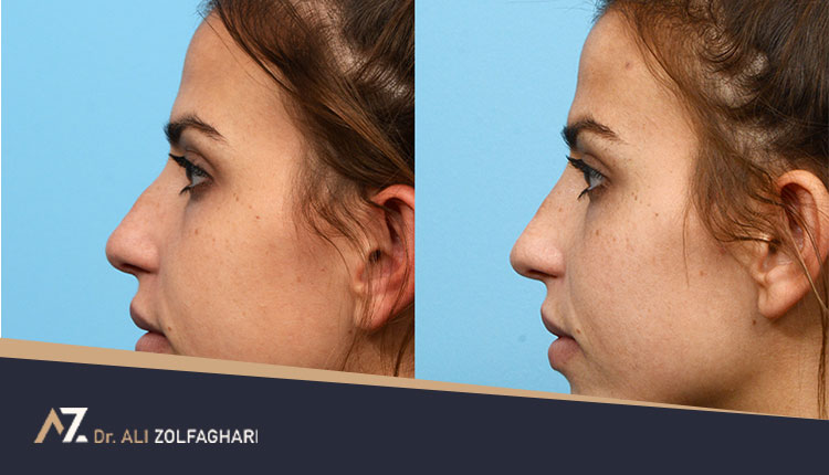 اصلاح قوز بینی بدون جراحی | دلایل و روش های رفع