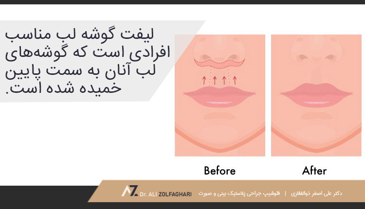 لیفت لب اصلاح شده