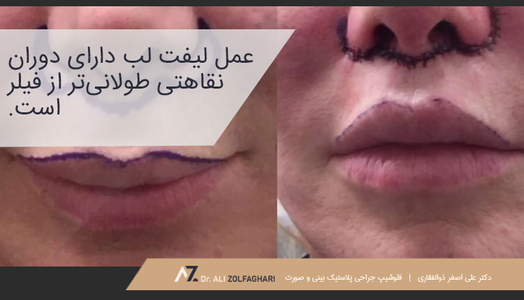 فیلر و لیفت لب، کدام بهتر است؟