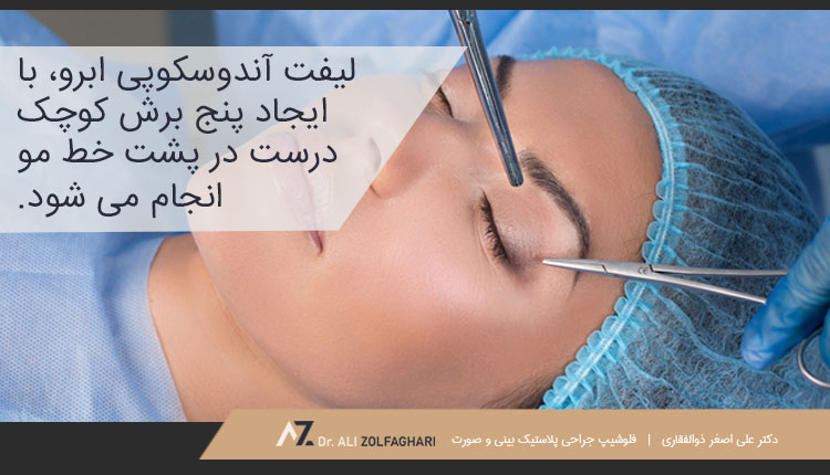 لیفت آندوسکوپی ابرو