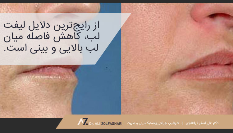 لیفت لب به چه دلایلی انجام می‌شود؟