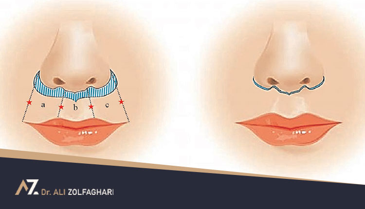 همه چیز درباره لیفت لب (سانترال لب)