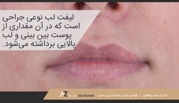 لیفت لب چیست؟