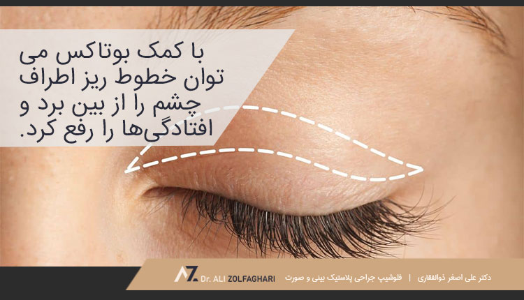 لیفت چشم با بوتاکس