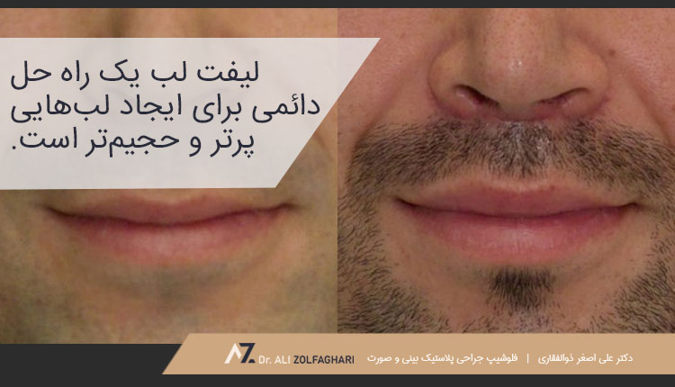 معایب لیفت لب