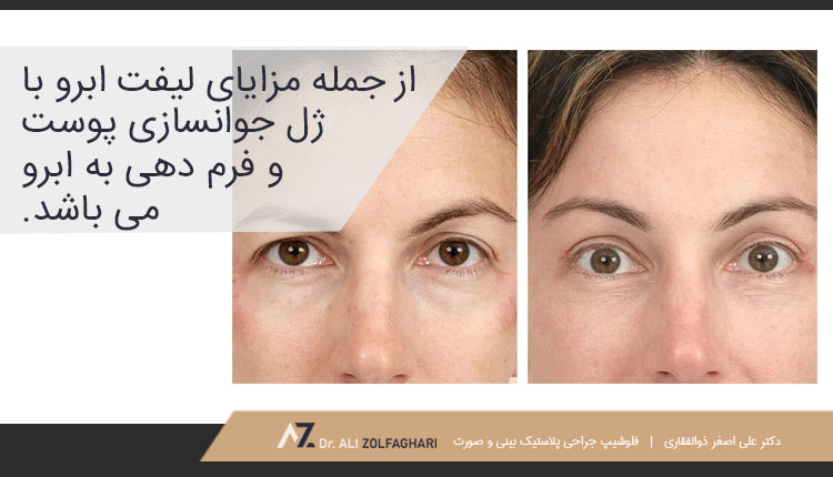 مزایای لیفت ابرو با ژل