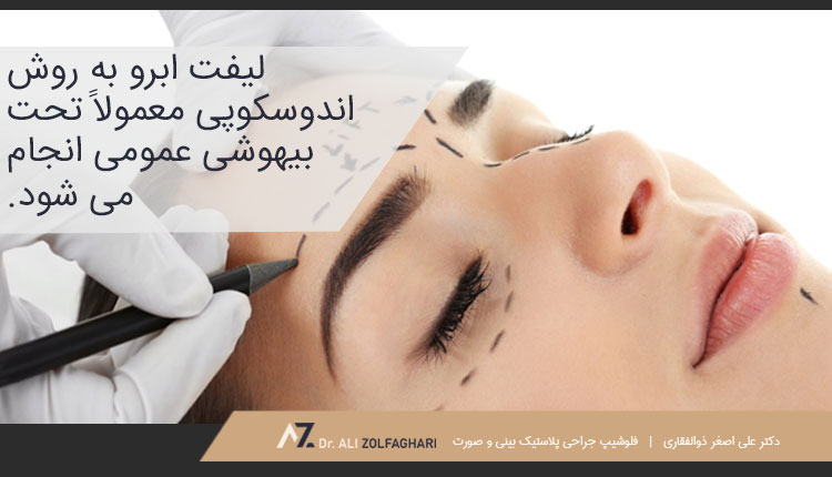 مراحل عمل لیفت اندوسکوپیک