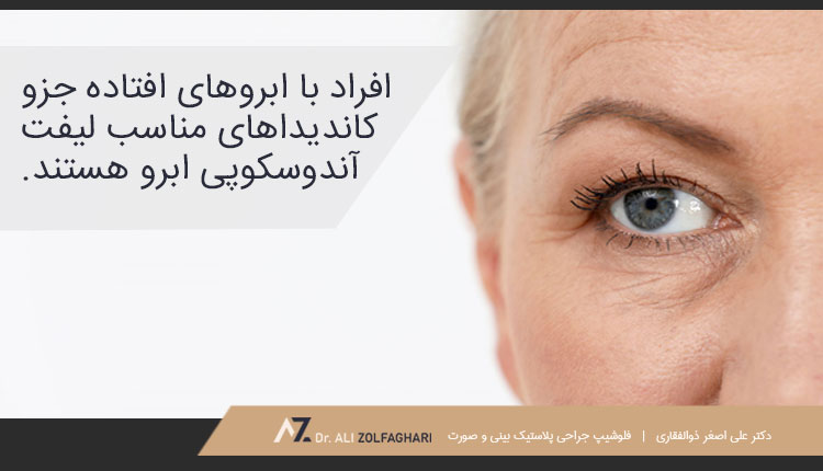 کاندیدای مناسب لیفت اندوسکوپیک