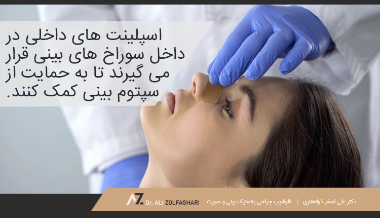 اسپلینت های داخلی بینی