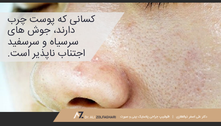 جوش زدن به دلیل بهداشت نامناسب بینی بعد از جراحی بینی