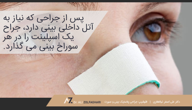 روند قرار گرفتن اسپلینت بینی