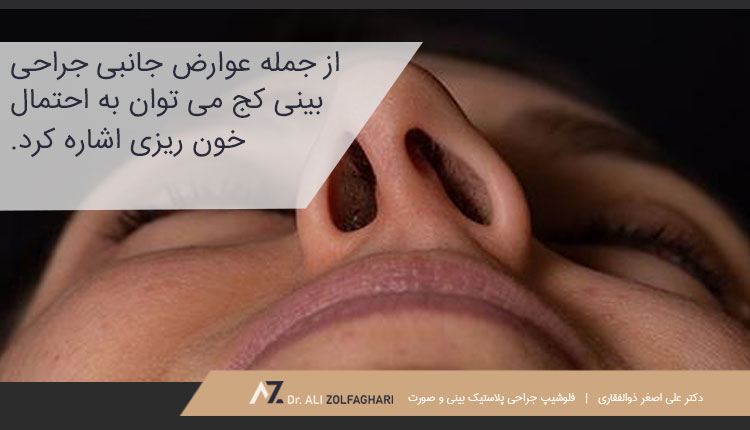 عوارض جانبی جراحی بینی کج
