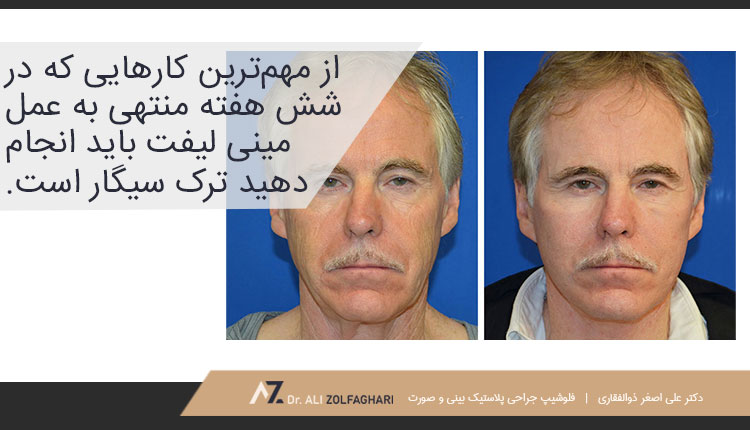 مراقبت‌های لازم پیش از انجام مینی لیفت صورت