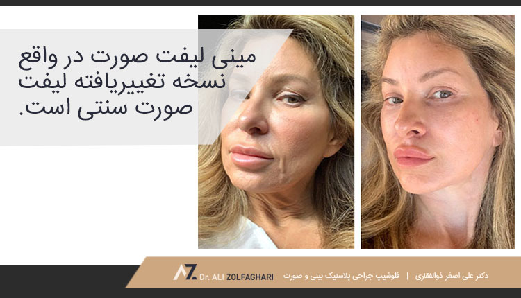 مینی لیفت صورت چیست؟