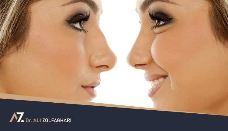 اثرات خنده و گریه بعد از عمل بینی
