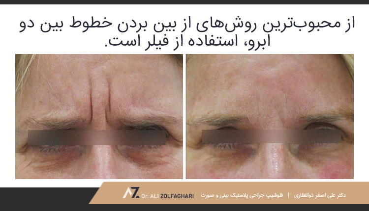 از بین بردن خط اخم با فیلر