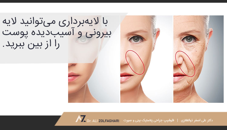 از بین بردن خط لبخند با لایه‌برداری شیمیایی