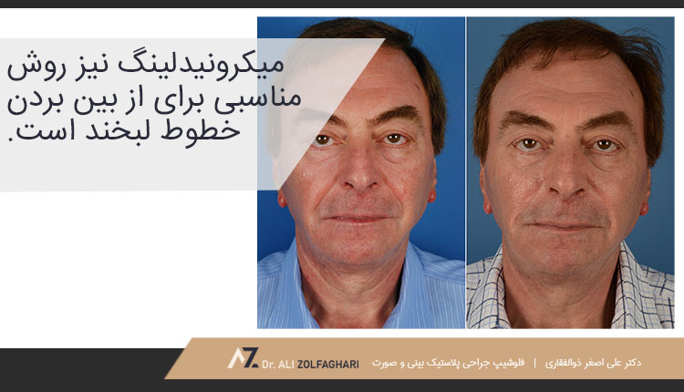 میکرونیدلینگ