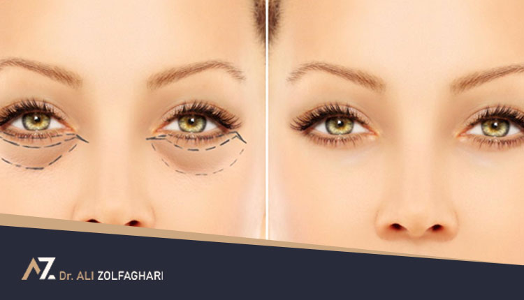 راهنمای جامع جراحی بلفاروپلاستی پلک پایین + مزایا، روش انجام و عوارض
