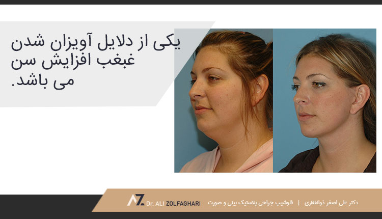 دلایل آویزان و بزرگ شدن غبغب