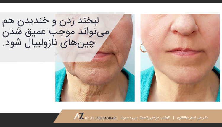 دلایل ایجاد شدن خط خنده