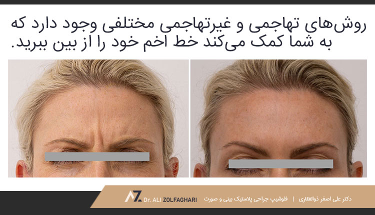 روش‌های از بین بردن خط اخم