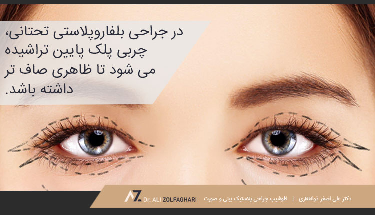 روند و نحوه انجام بلفاروپلاستی پلک پایین
