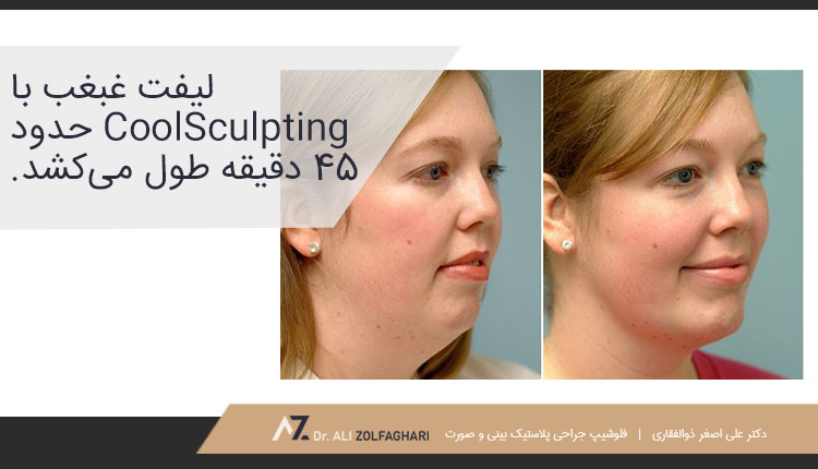 لیفت غبغب با CoolSculpting
