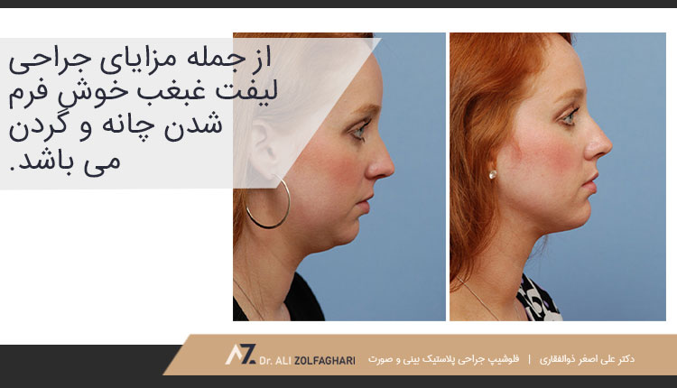 مزایای جراحی لیفت غبغب