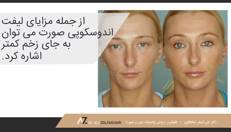 مزایای لیفت اندوسکوپی صورت