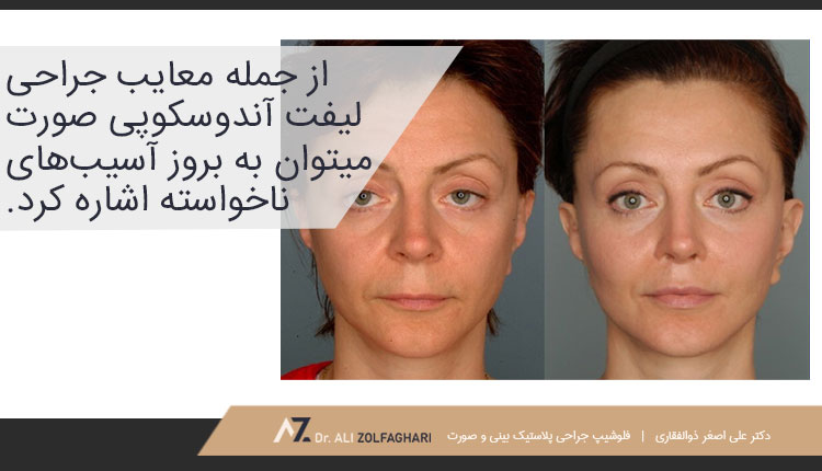 معایب جراحی لیفت آندوسکوپی صورت