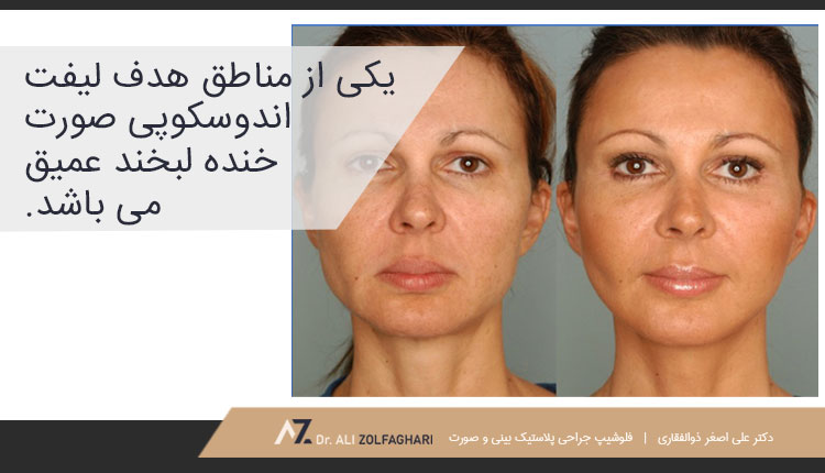 مناطق هدف لیفت اندوسکوپی صورت