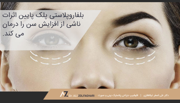 چرا بلفاروپلاستی انجام دهیم؟