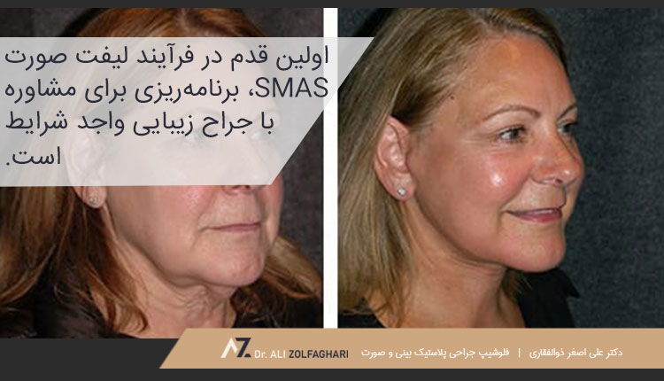 لیفت صورت SMAS چگونه انجام می‌شود؟