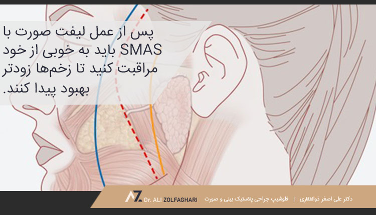 مراقبت‌های لازم پس از لیفت صورت با SMAS