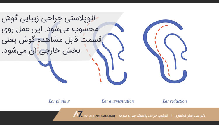 اتوپلاستی چیست؟