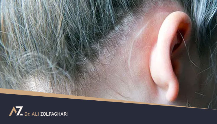 افراد مناسب برای جراحی گوش چه کسانی هستند؟
