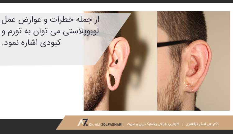 نکاتی که درباره جراحی نرمه گوش باید بدانید