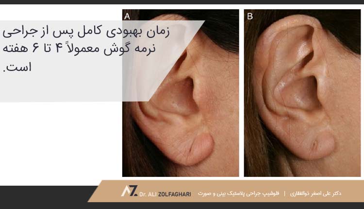 روند بهبودی پس از لوبو پلاستی